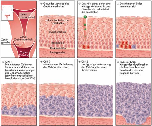 Hpv warzen mund - Terminvereinbarung